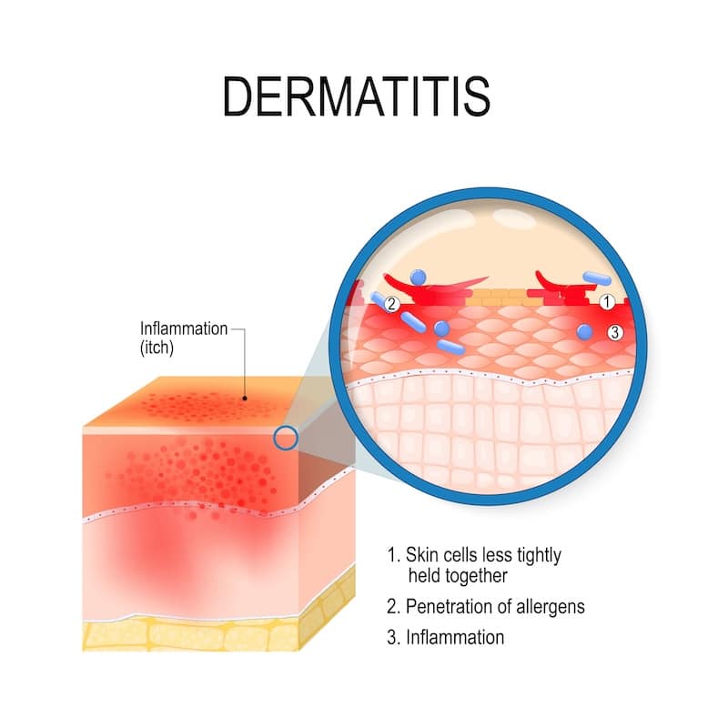 contact dermatitis 1